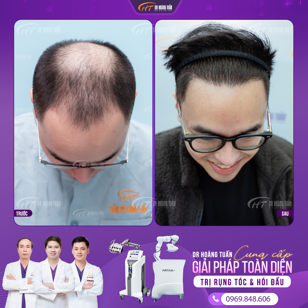 hói đầu có chữa được không